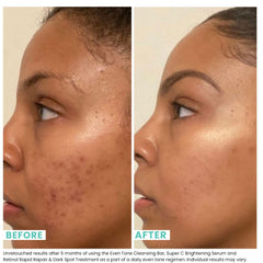 Urban Skin Rx Even Tone Bar lather on face demonstrates creamy cleansing action.