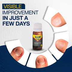 URIEL Upgraded kit in use for safe at‑home ingrown nail removal