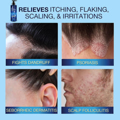 Uttse antifungal shampoo ingredients include salicylic acid and natural botanicals.
