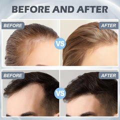 VANKEPYO Derma Roller hair 0.25mm supports scalp micro-stimulation.