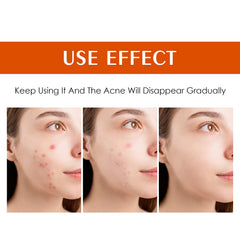 Back view of YAFUSIPE acne treatment for body breakouts with moisturizing care.