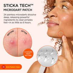 ZitSticka Killa Mini patch applied on the face for discreet zit care