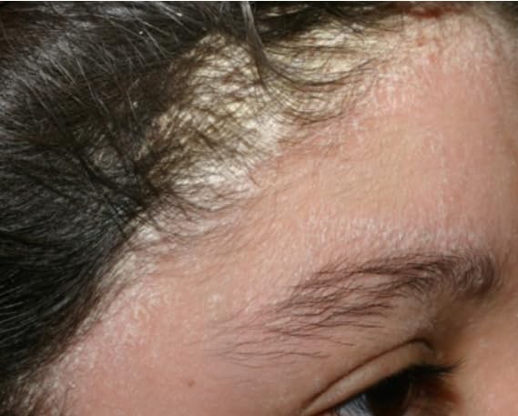 111MedCo bar integrated into a dandruff-related skin routine