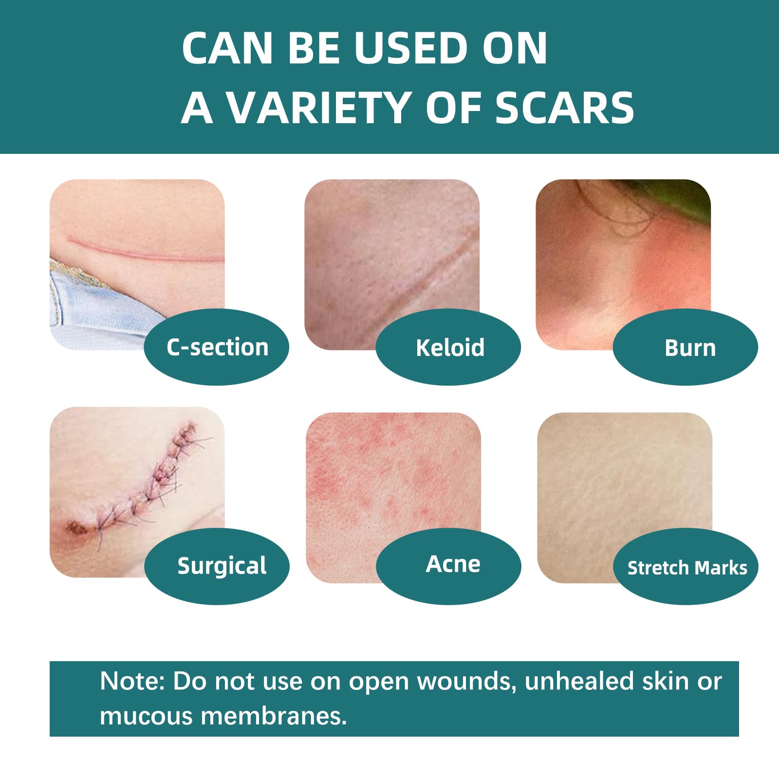 IBEELIV silicone scar gel sheets waterproof design stays in place during daily activities.