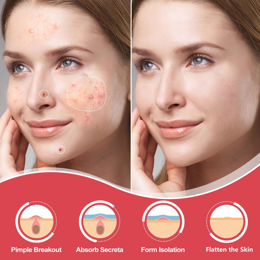 AcneGo hydrocolloid patches on skin show strong adhesion and water-resistant protection for overnight use.