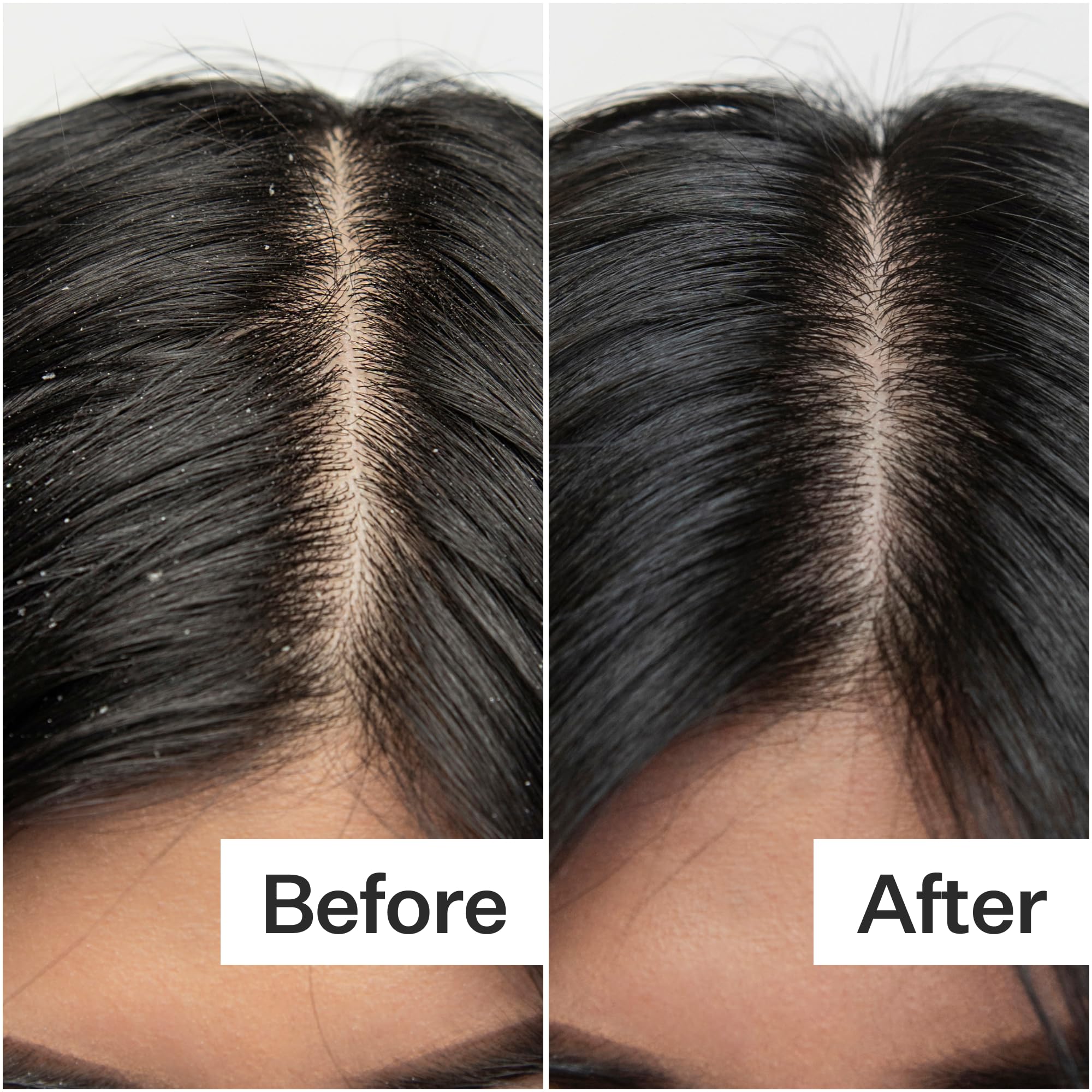 ACT+ ACRE scalp-flakes close-up shows reduction in visible buildup with weekly use.