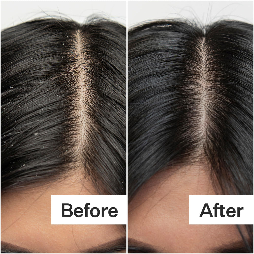 ACT+ ACRE scalp-flakes close-up shows reduction in visible buildup with weekly use.
