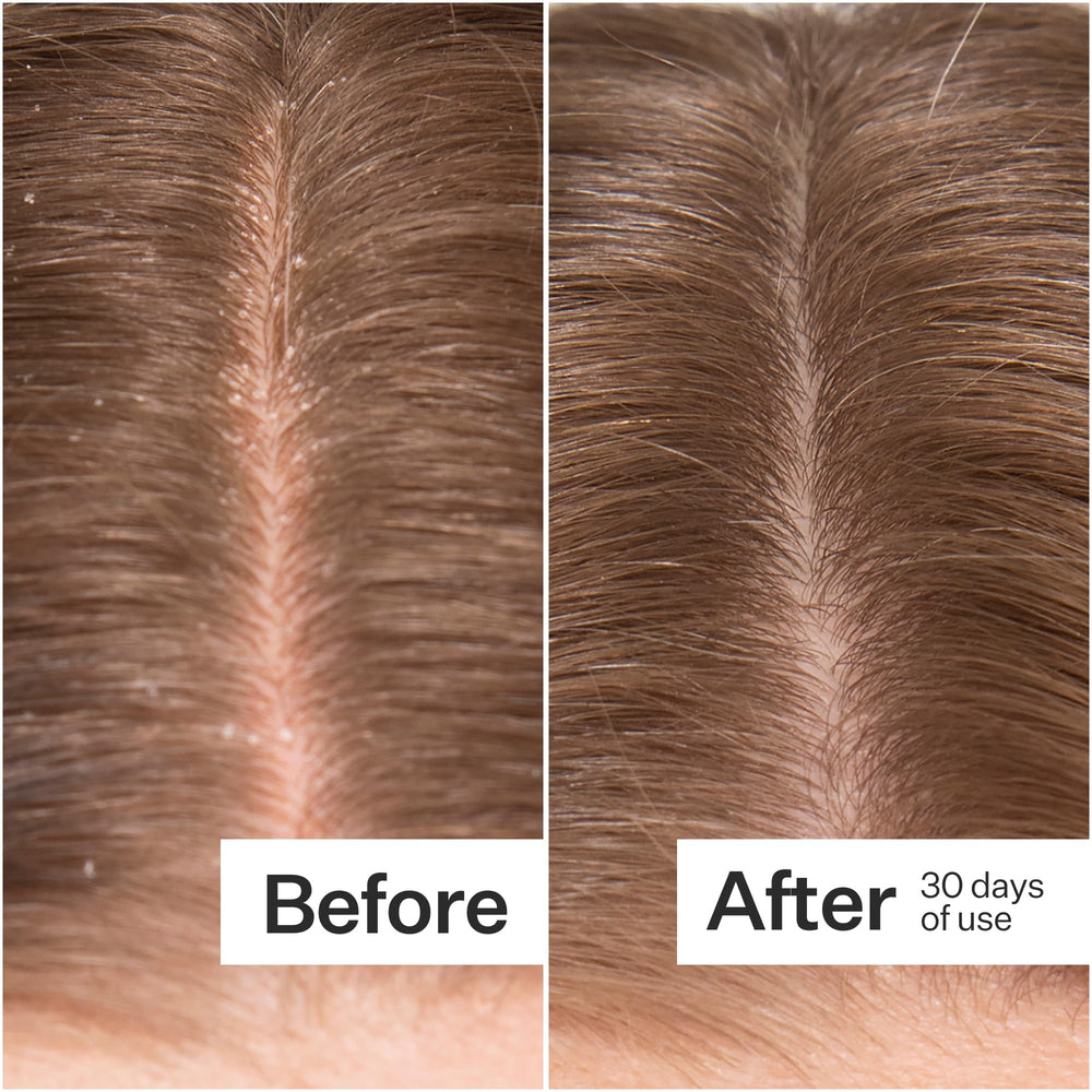 ACT+ ACRE scalp serum pipettes enable precise scalp application for itch relief.