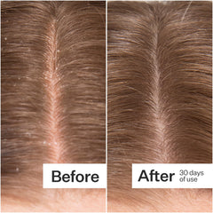 ACT+ ACRE scalp serum pipettes enable precise scalp application for itch relief.