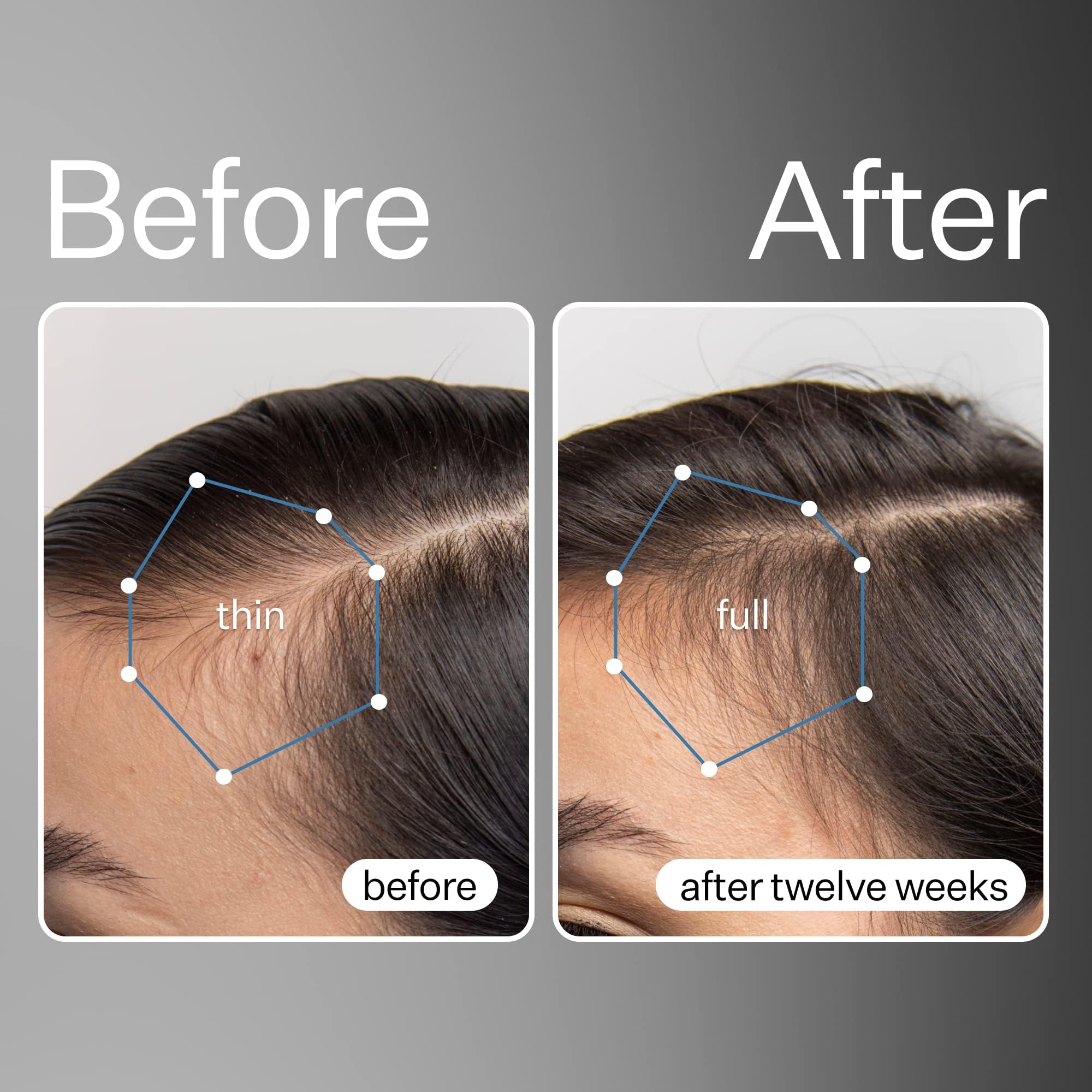 ACT+ACRE stem-cell serum dropper in use for easy scalp application.