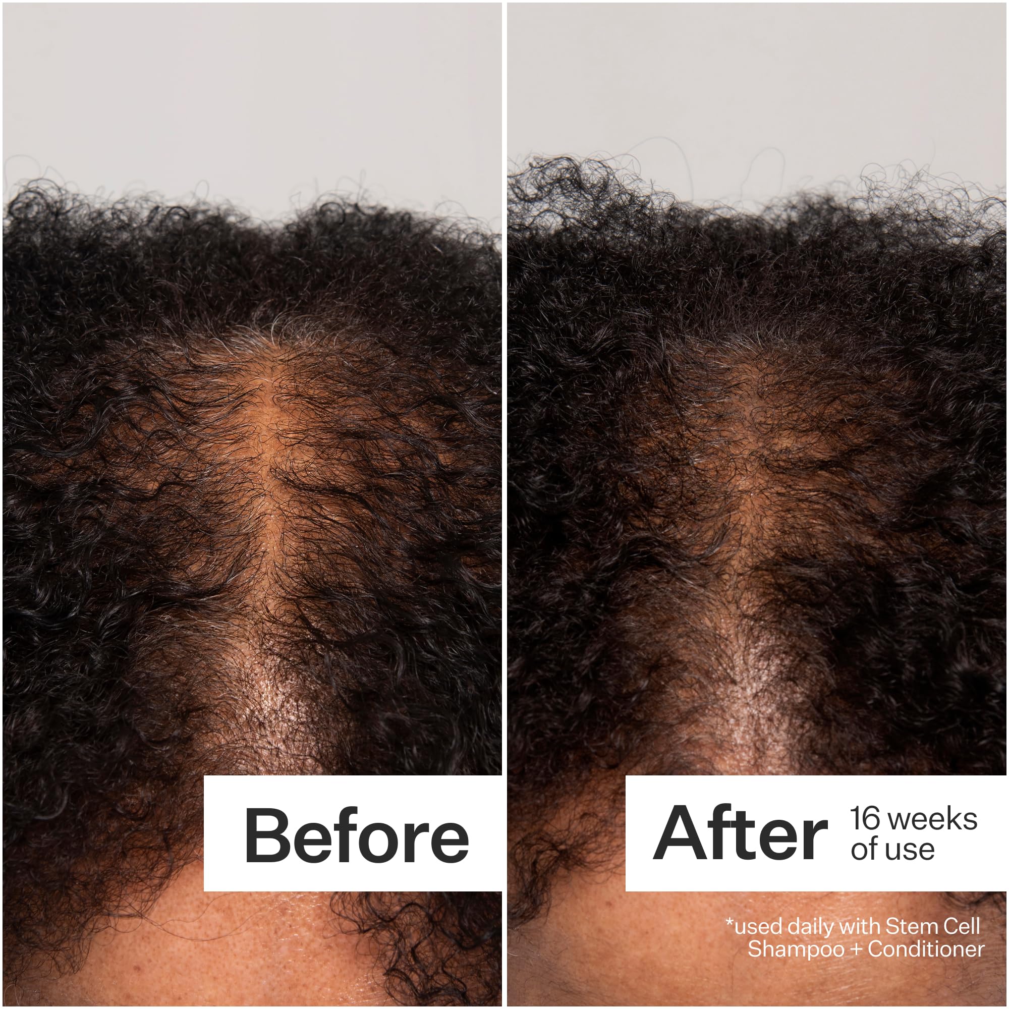 Act+Acre product image hints at slower shedding and visible improvement