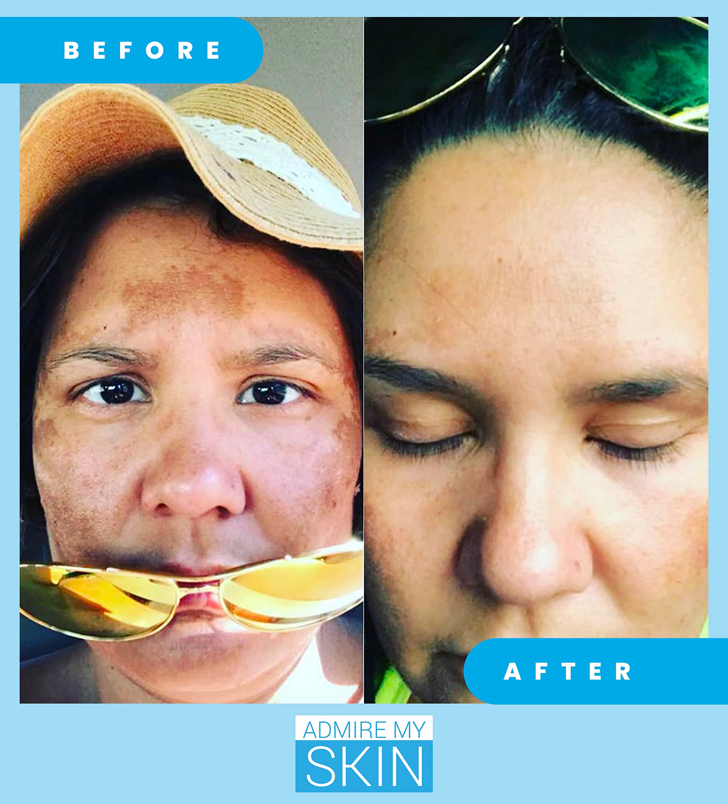 Admire My Skin before-after photos show real-world discoloration improvements.