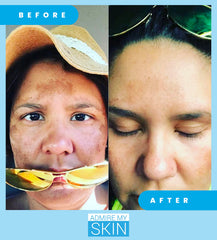Admire My Skin before-after photos show real-world discoloration improvements.