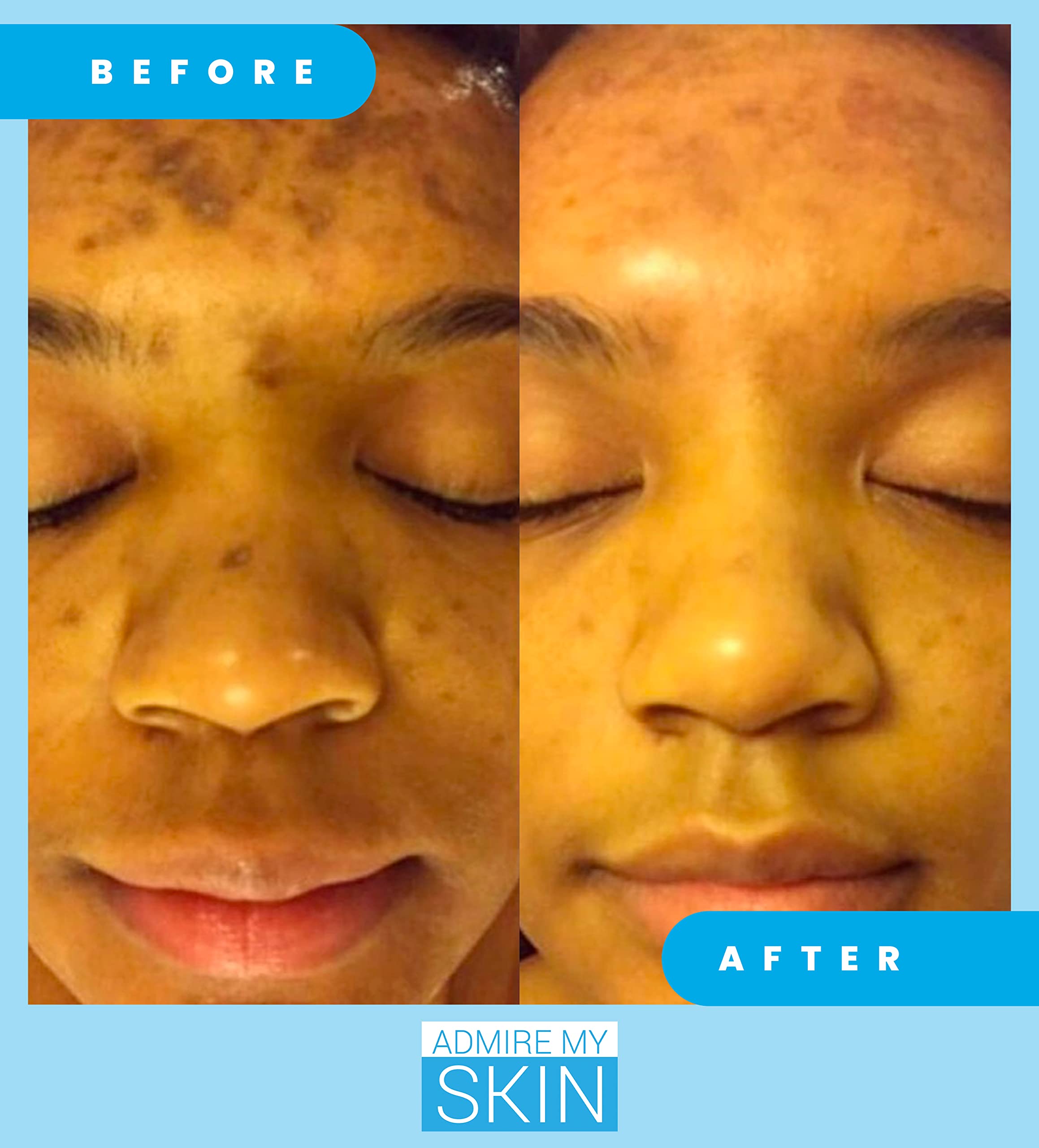 Admire My Skin kojic acid azelaic acid serum bottle indicates multitarget formulation for skin tone.