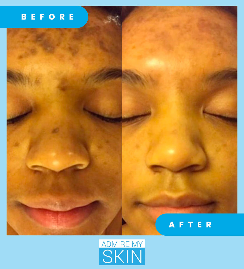 Admire My Skin kojic acid azelaic acid serum bottle indicates multitarget formulation for skin tone.