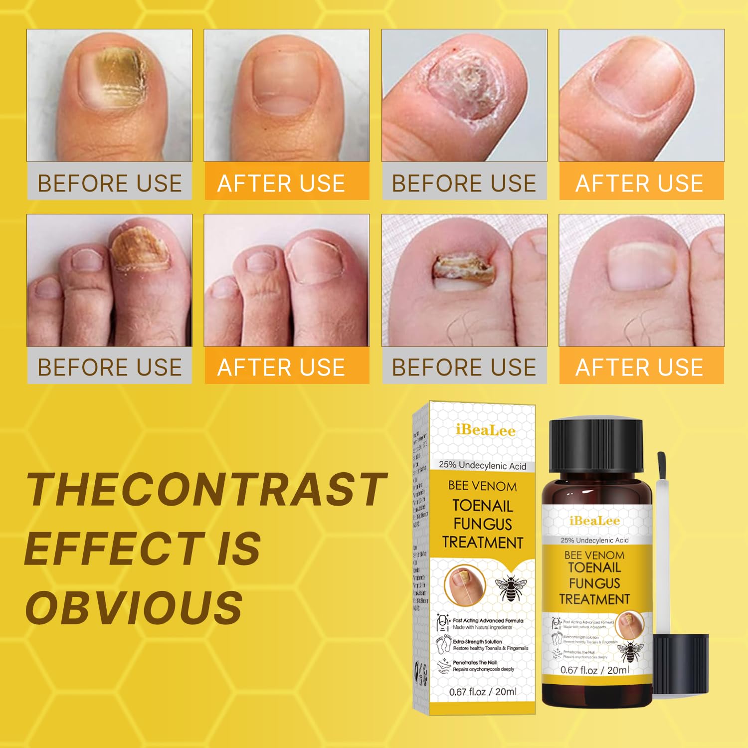 Cream-on-nail segment for layered antifungal treatment