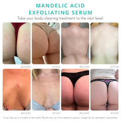 Almond Clear Level 2 Acne Serum label-closeup highlighting mandelic acid formula.