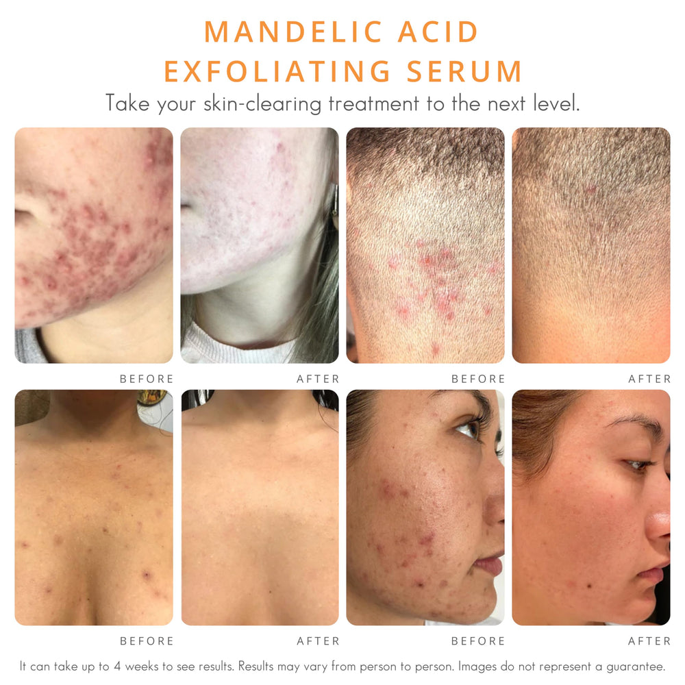 Almond Clear dark spots before after illustrates potential brightening and even skin tone.