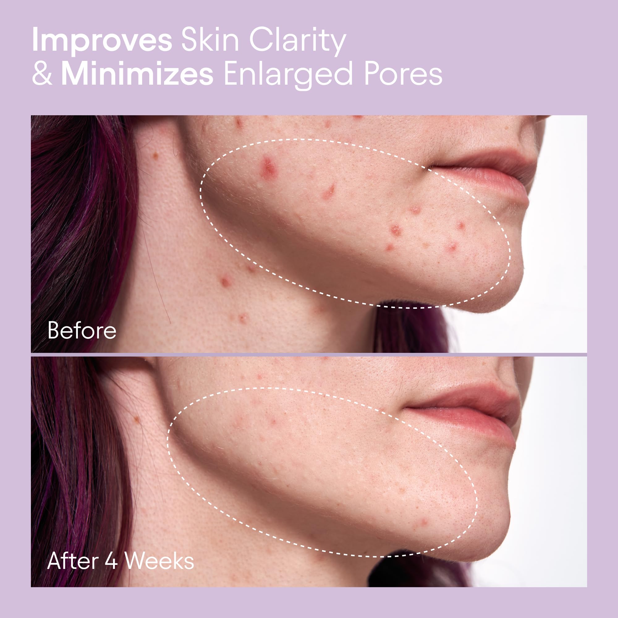 Alpyn Beauty liquid exfoliator texture shown, suggesting gentle resurfacing and clarity.