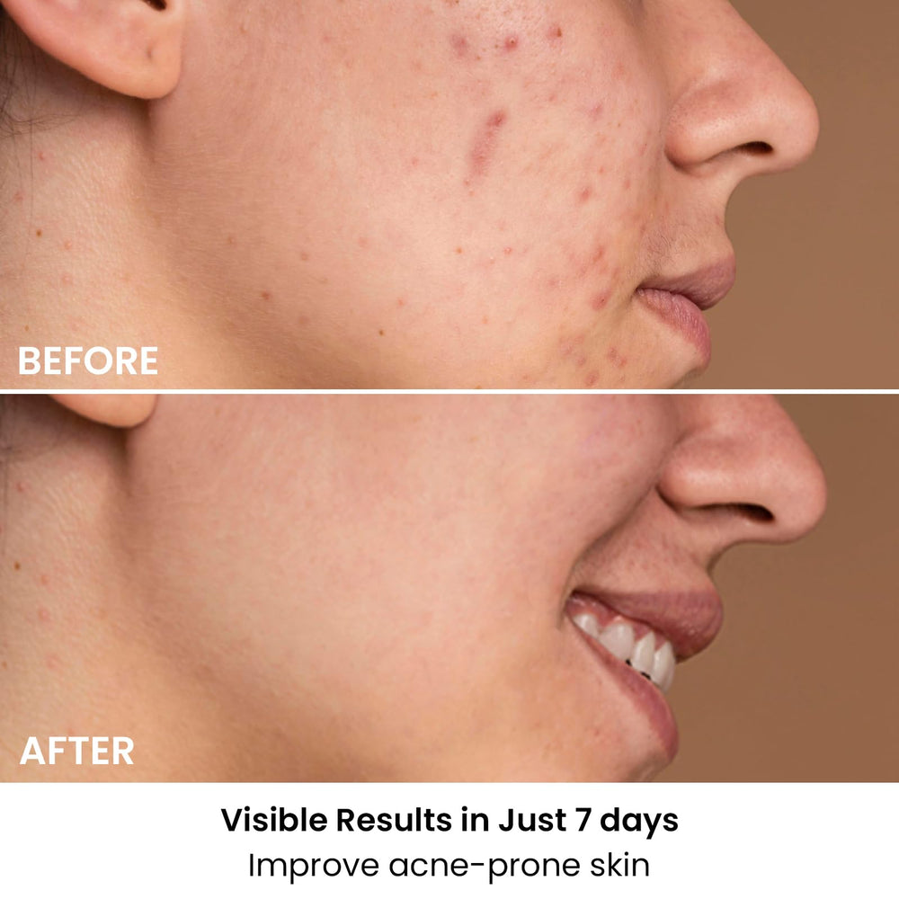 AMIRO Spectra Purify mode close-up illustrates blue light for targeted pore cleansing