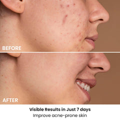 AMIRO Spectra Purify mode close-up illustrates blue light for targeted pore cleansing