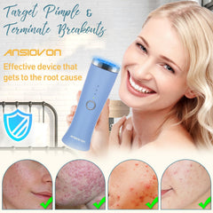 ANSIOVON battery-powered blue light wand offers convenient at-home acne care