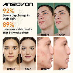 ANSIOVON handheld wand in use on the cheek for targeted treatment