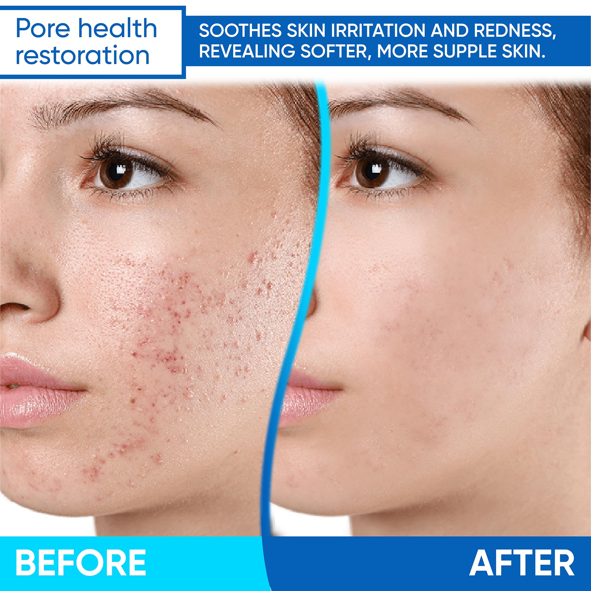AOBBIY Azelaic Acid Cream on blemish-prone skin for targeted daily care.