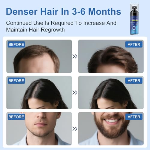 AOOLCF Minoxidil Spray thinning-hair focus promotes thicker appearance and volume.