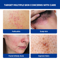 AOSORW Folliculitis Cream back use for post workout comfort