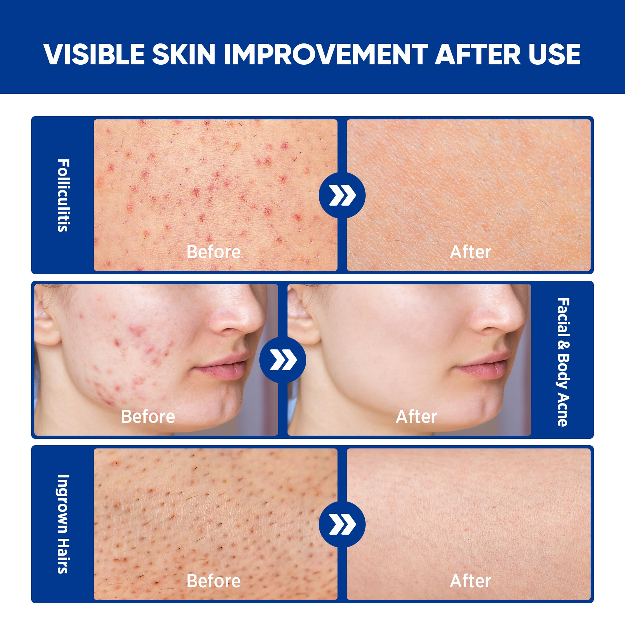 AOSORW Folliculitis Cream with tea tree oil promotes fresh skin