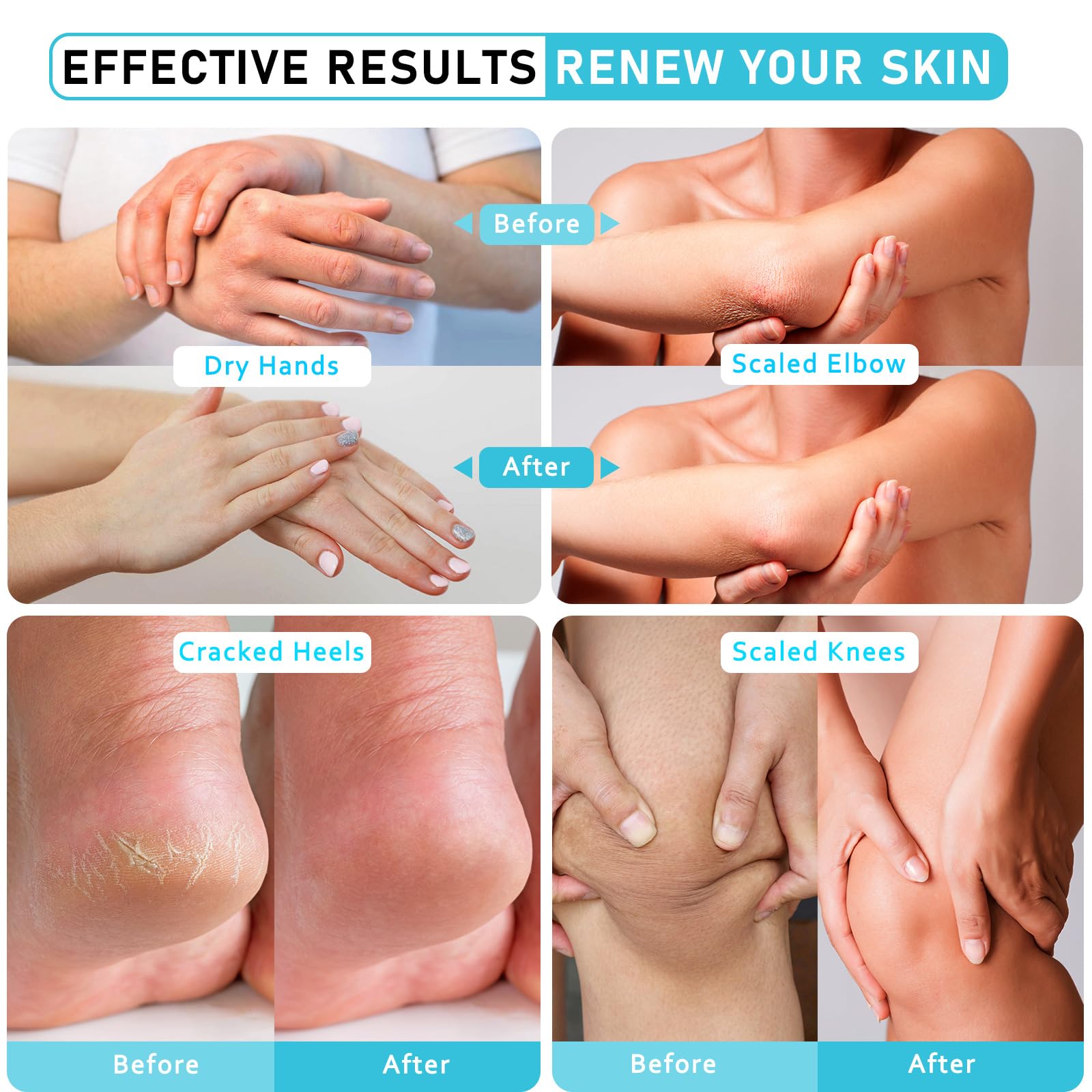 Aphesia Urea 40% application on hands demonstrates versatile use for dry skin.