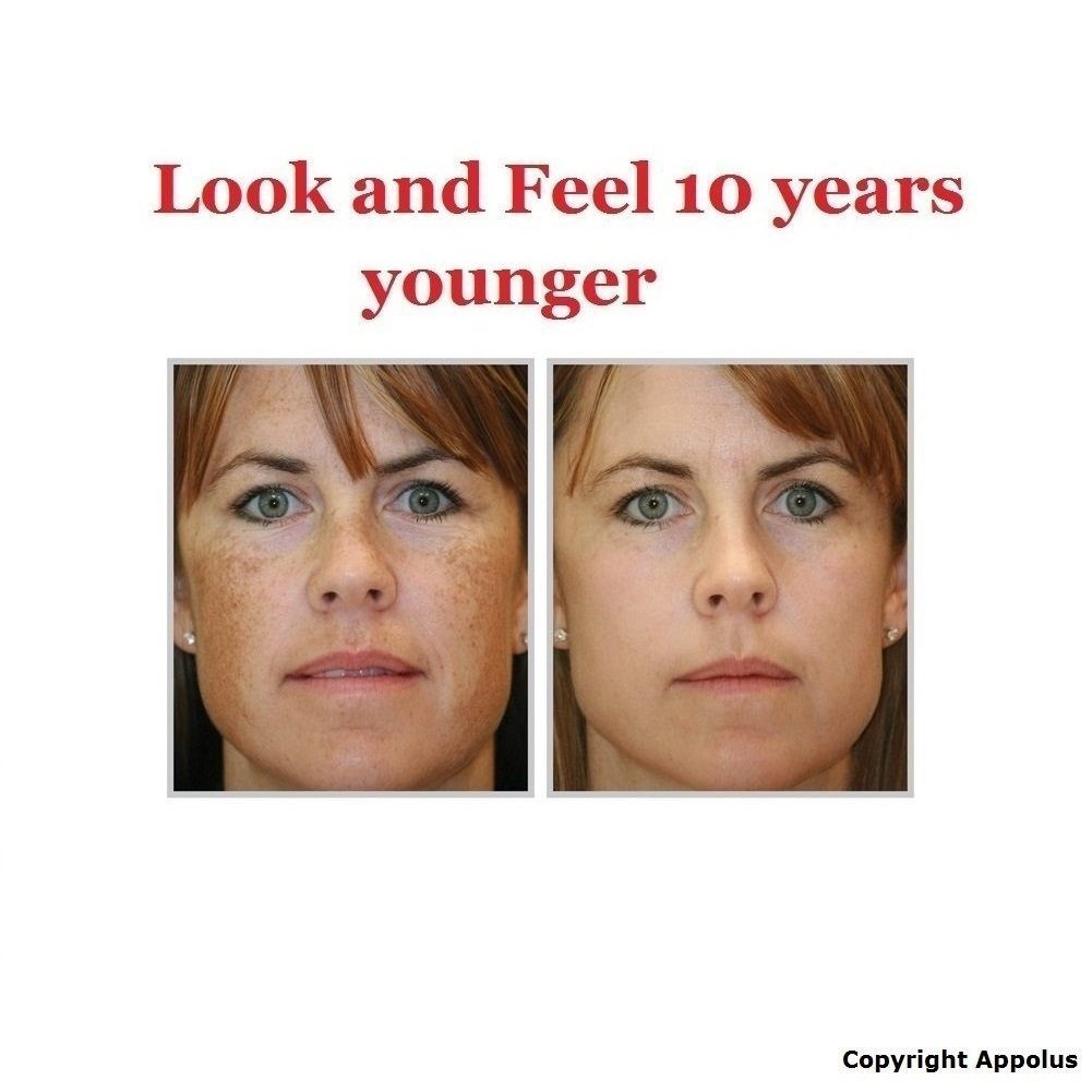 Appolus microdermabrasion at-home use in a comfortable skincare routine.