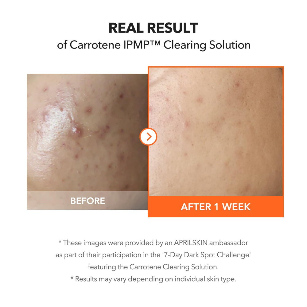 APRILSKIN Carrotene IPMP label emphasizing 5% Niacinamide to control oil.