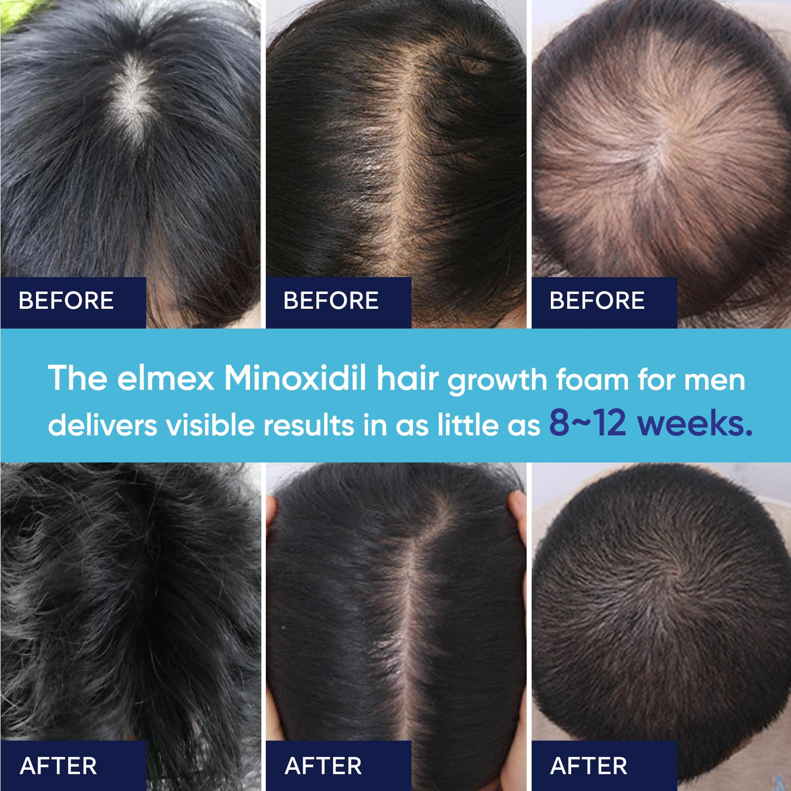 Artimore Minoxidil Foam used by women for thinning hair support.