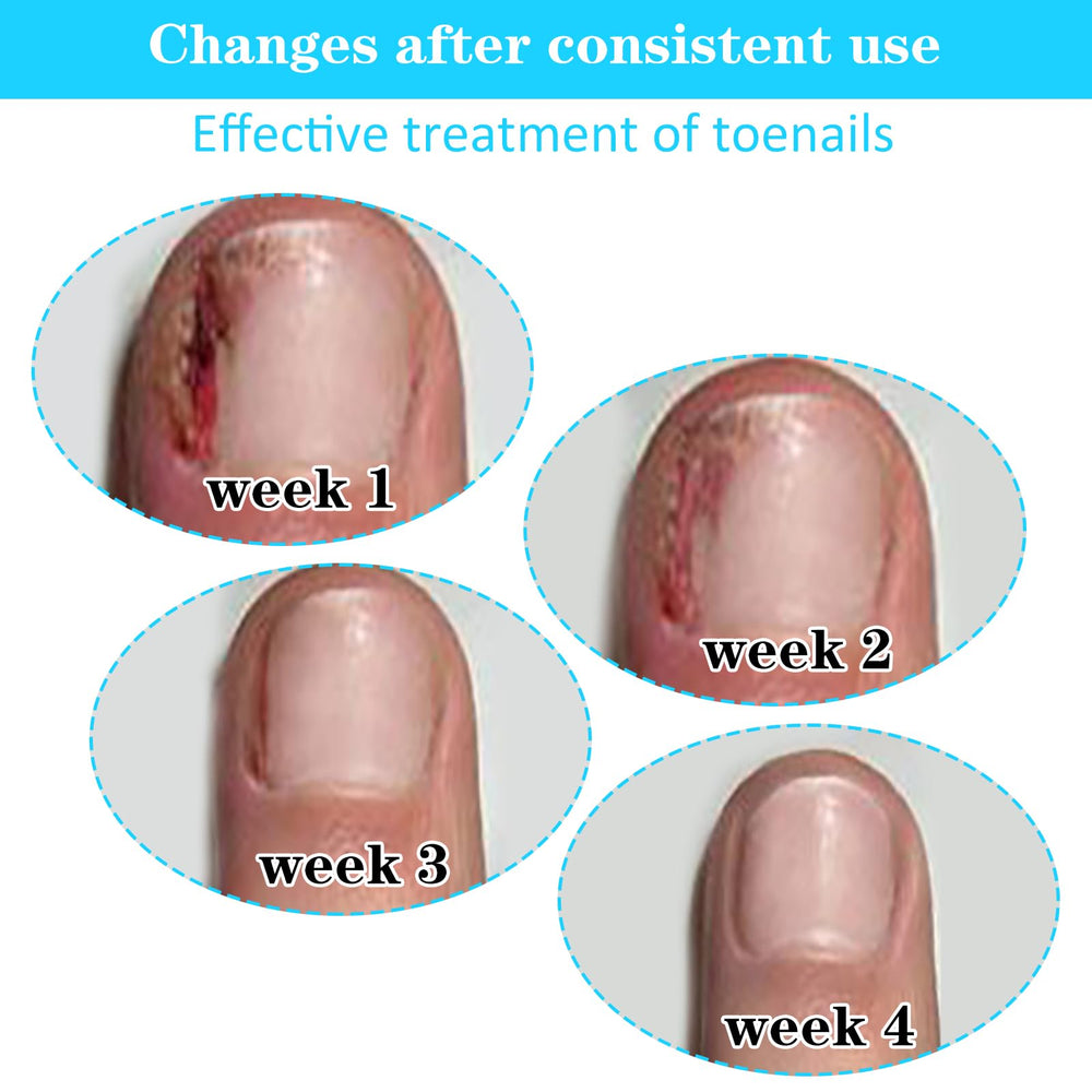 Aster kit cuidado pies profesional: solución versátil para uñas