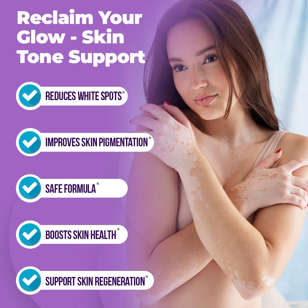 Aura Dermacare Vitiligo Cream applied to hands for daily use.