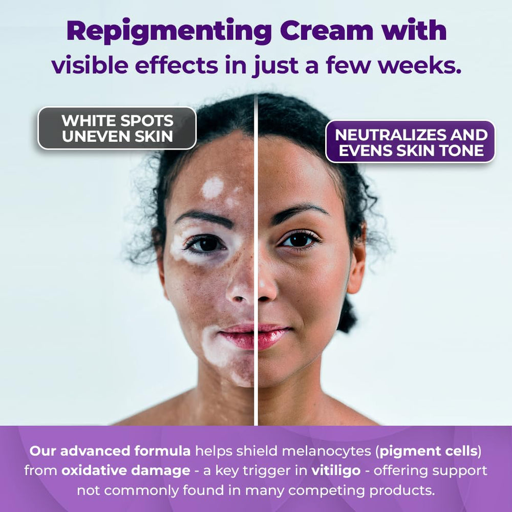 Aura Dermacare Vitiligo Cream USA-made label on jar.