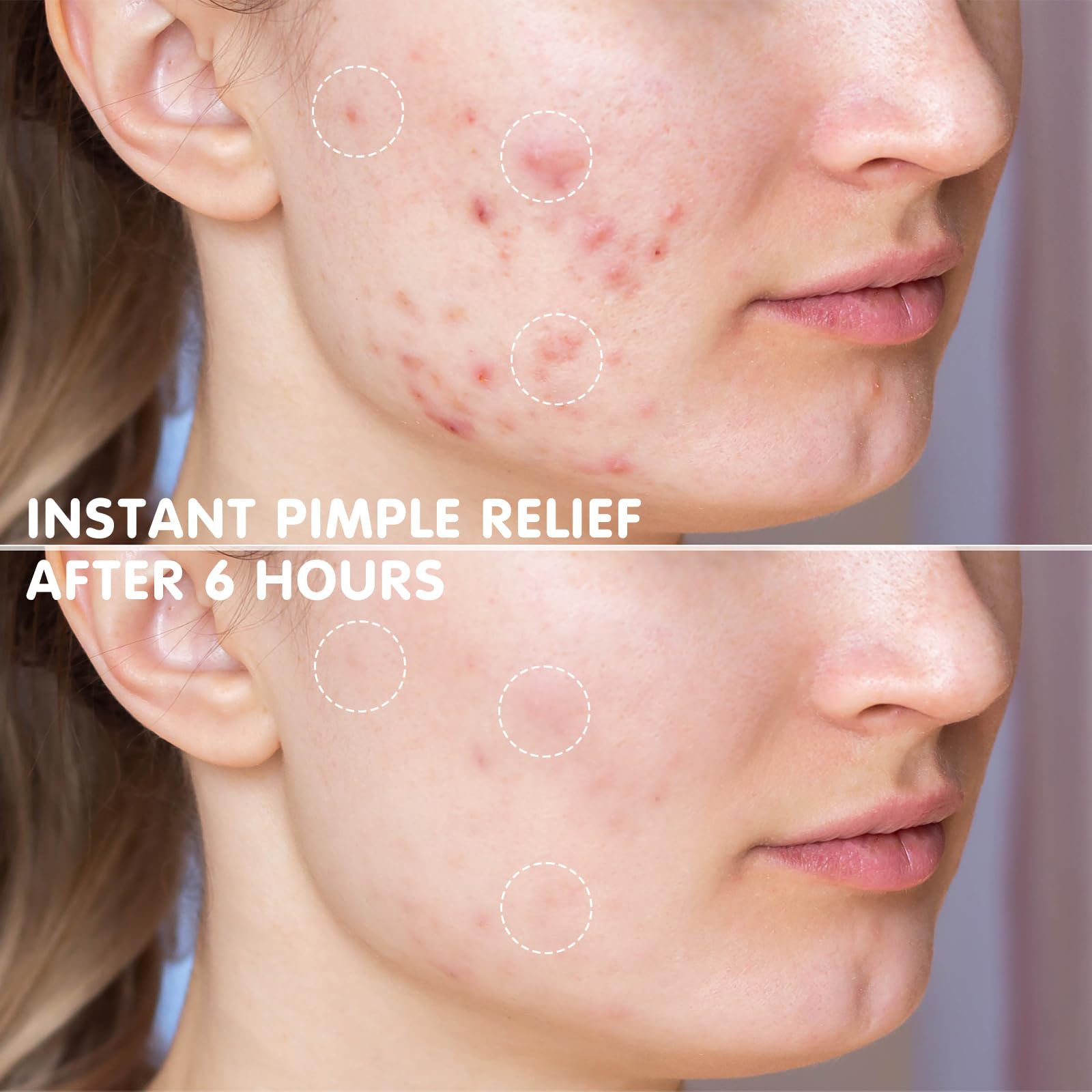 AUSLKA Star Pimple Patches compact pocket design ideal for purse emergencies.