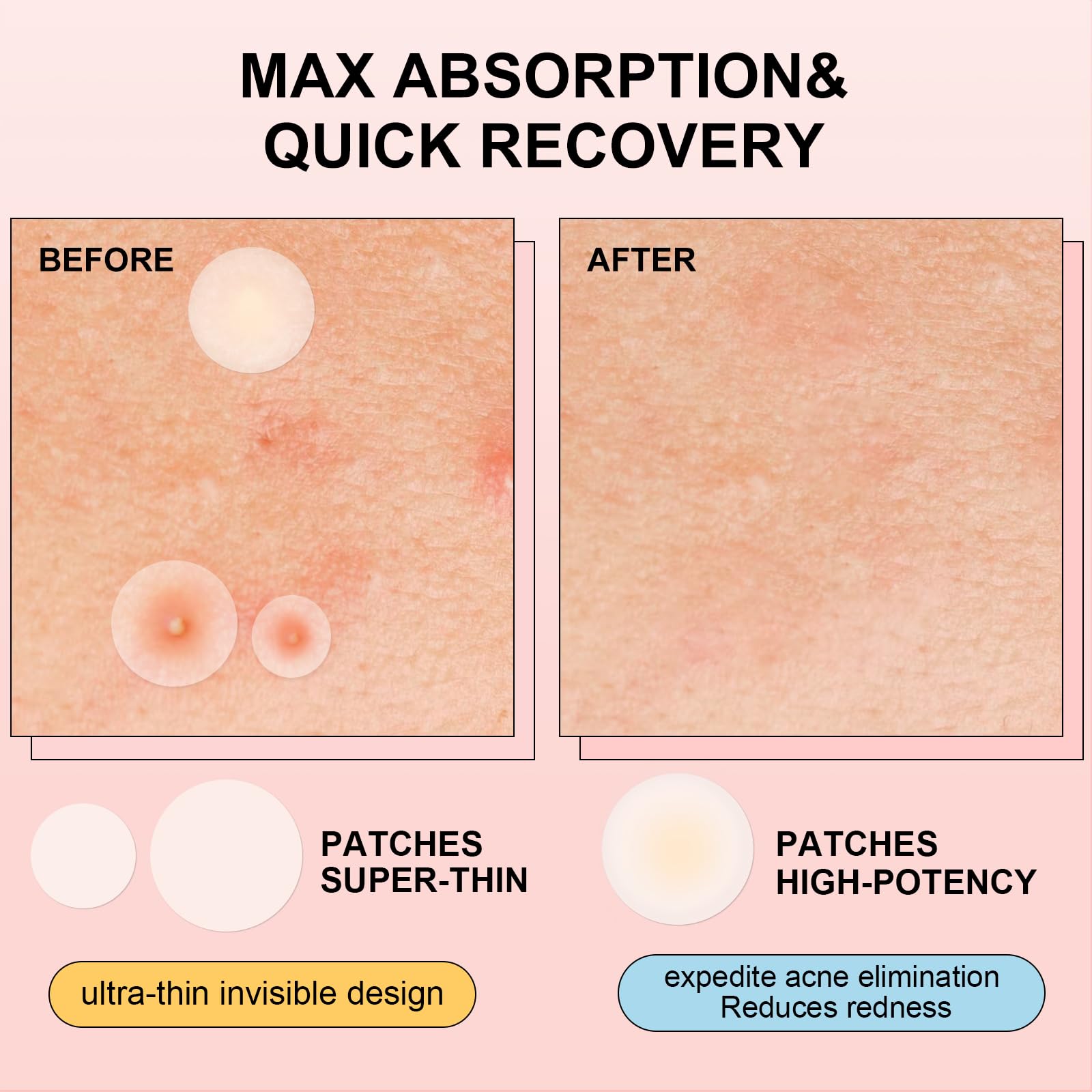 AVJONE Pimple Patches daytime invisible wear on skin.