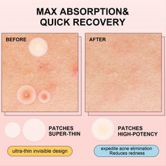 AVJONE Pimple Patches daytime invisible wear on skin.