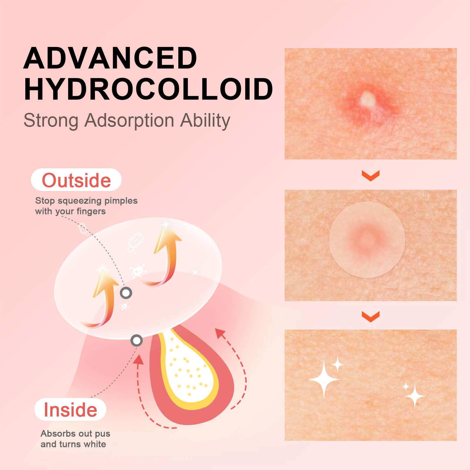 AVJONE Pimple Patches with tea tree oil closeup for soothing blemishes.