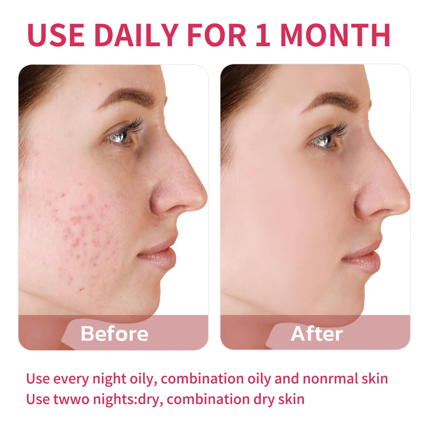 Azelaic Acid Acne Cream 20g travel-friendly tube for trips