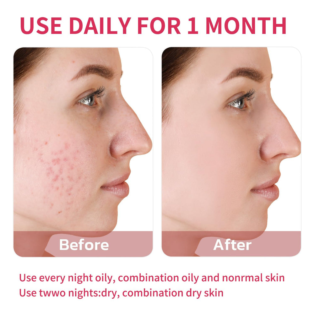 Azelaic Acid Acne Cream 20g travel-friendly tube for trips
