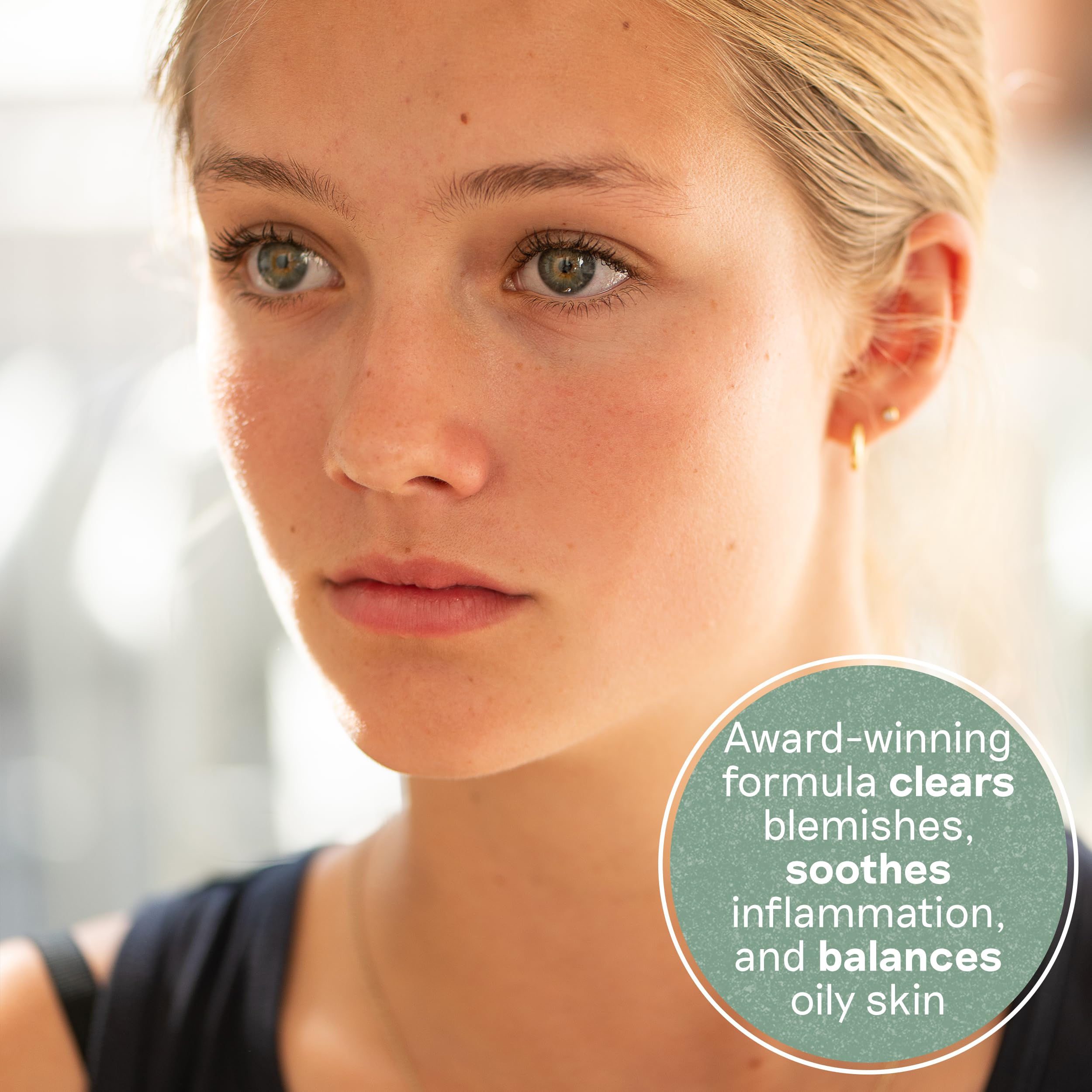Balance Me Congested Skin Serum dropper closeup highlights precise application for blemish-prone areas.