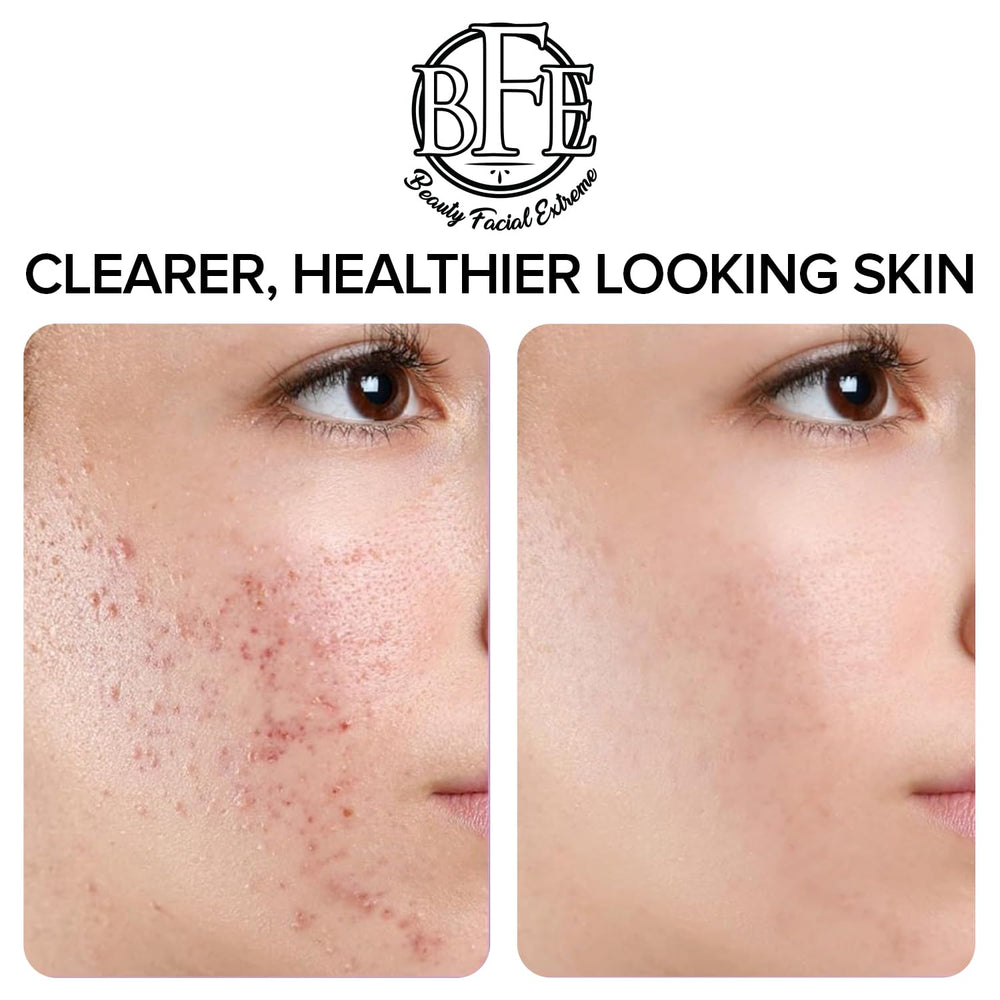 Beauty Facial Extreme acne pads anti-oil film reduces shine during day.