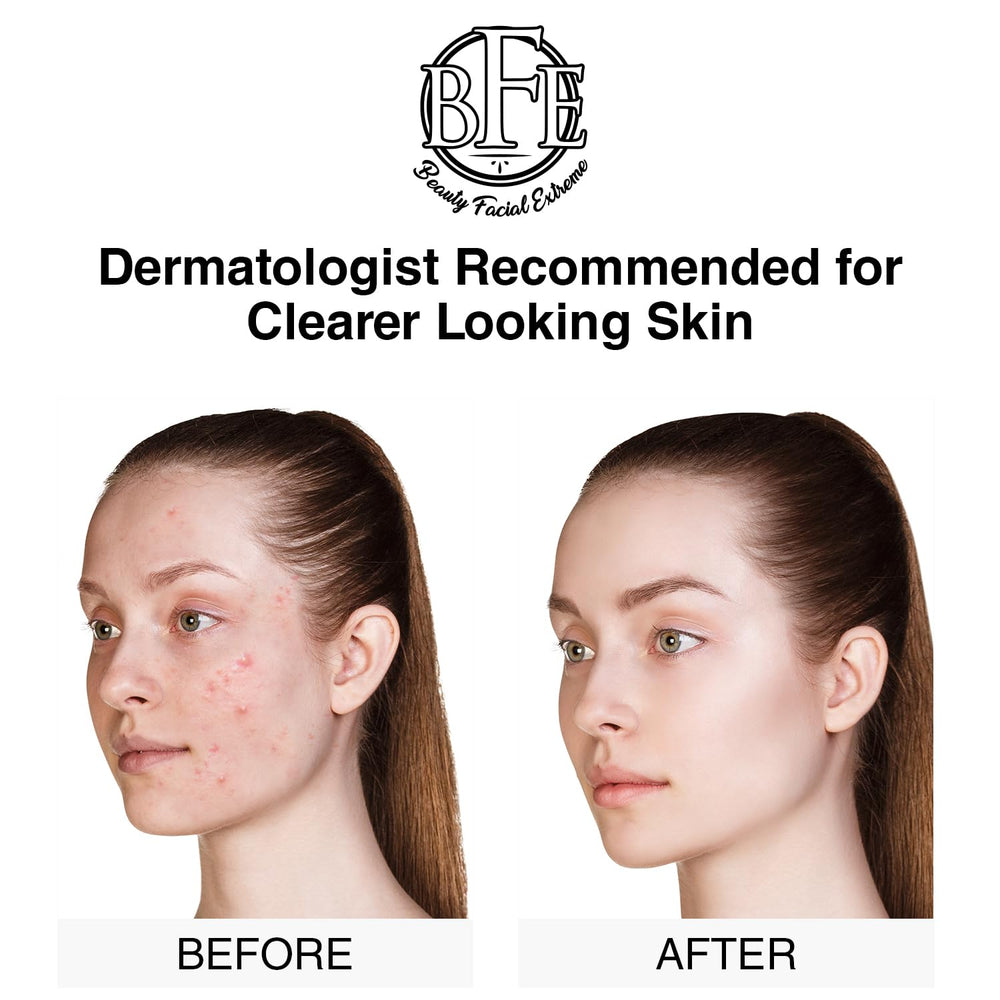Beauty Facial Extreme acne pads on face showing pore-clearing action.