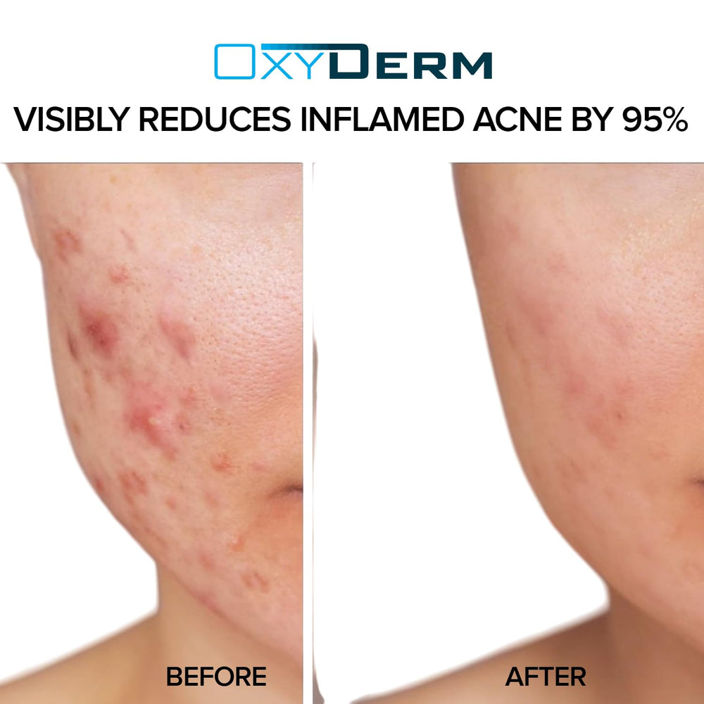 Beauty Facial Extreme acne pads right after use leaving refreshed skin.