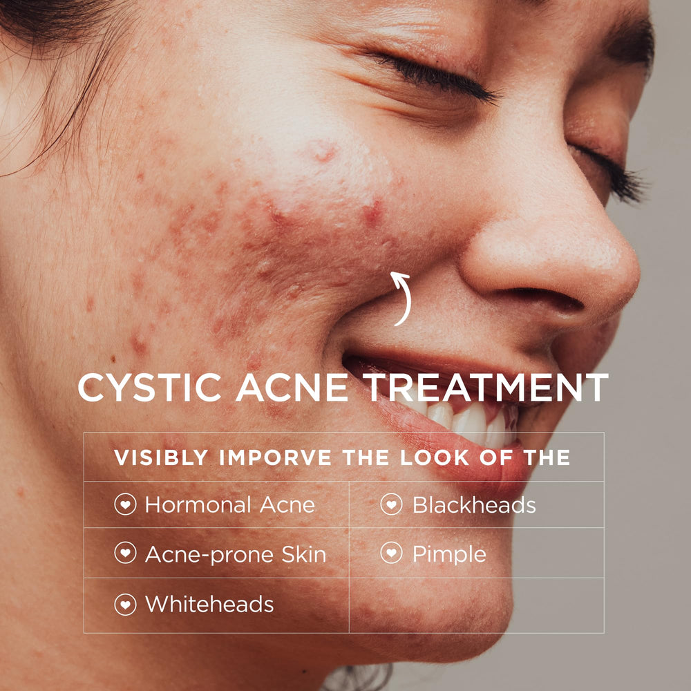 BellamiLuxx cystic acne cream dispense close-up shows easy application.