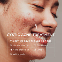 BellamiLuxx cystic acne cream dispense close-up shows easy application.